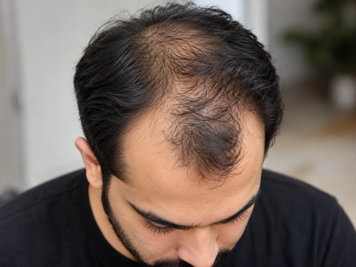 Male pattern hair loss with a receding hairline at the temples and a thinning crown
