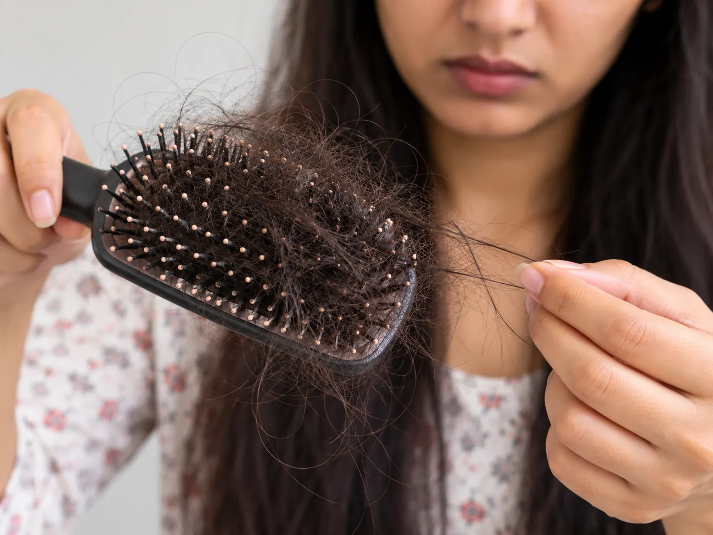 Handful of shed hair on a comb from sudden diffuse hair fall