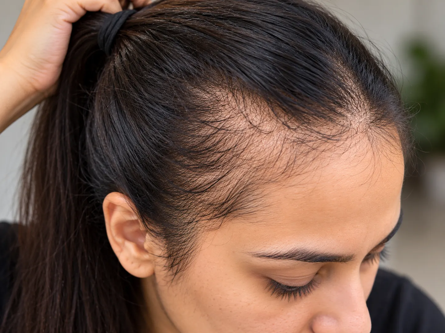 Hair thinning along the hairline from traction alopecia caused by tight hairstyles